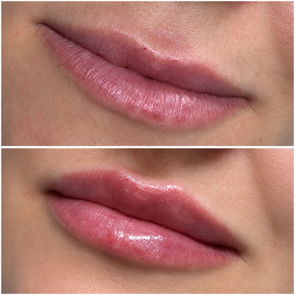 Lip treatment result