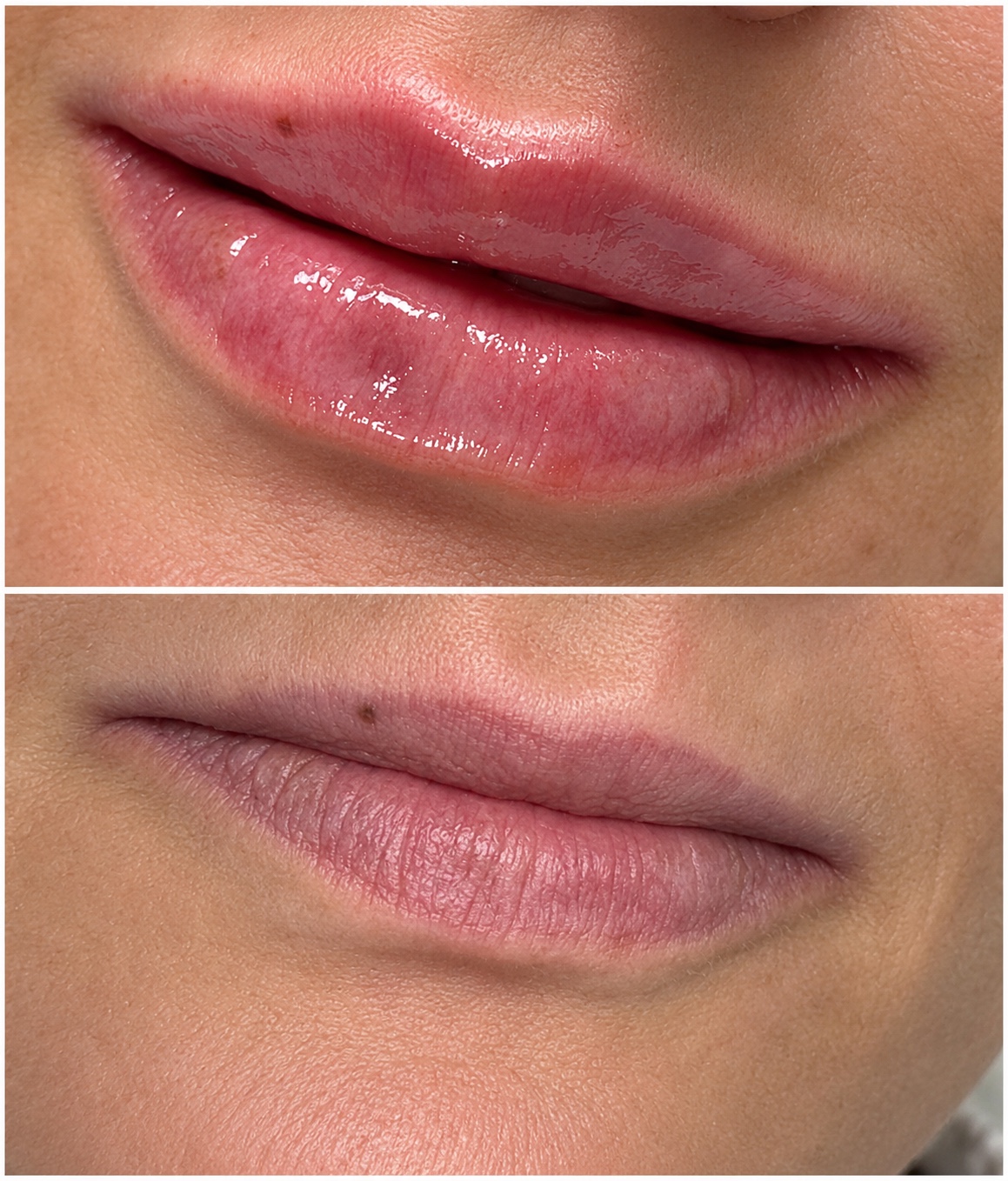 Lip treatment result