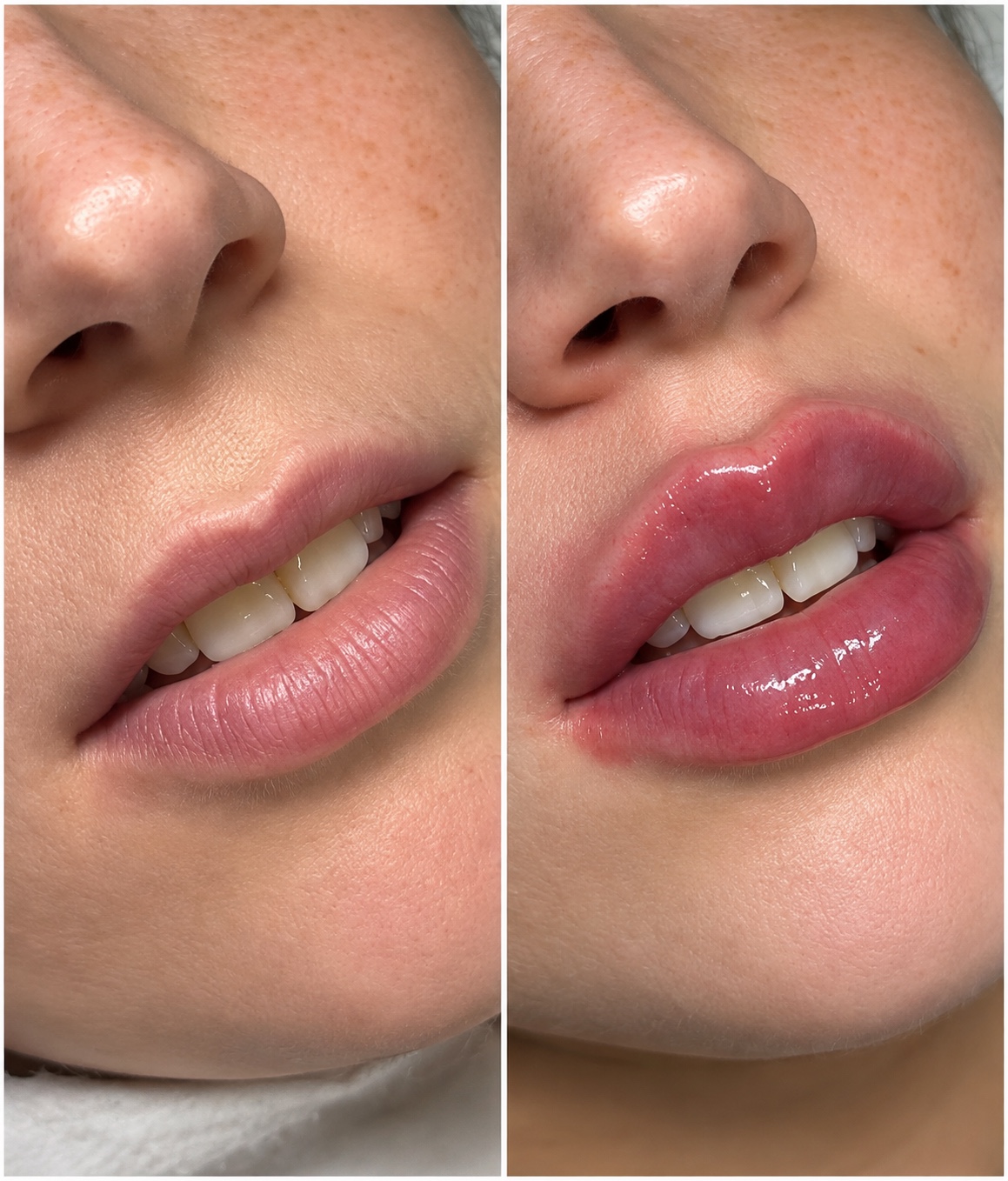 Lip treatment result