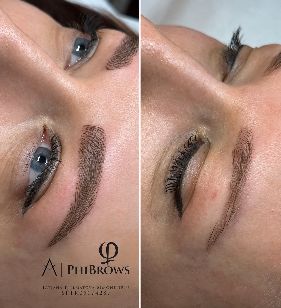 Brow treatment result