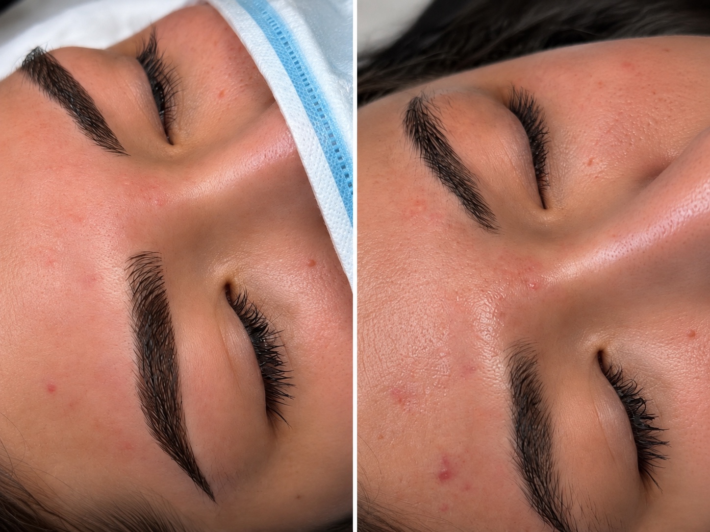 Brow treatment result