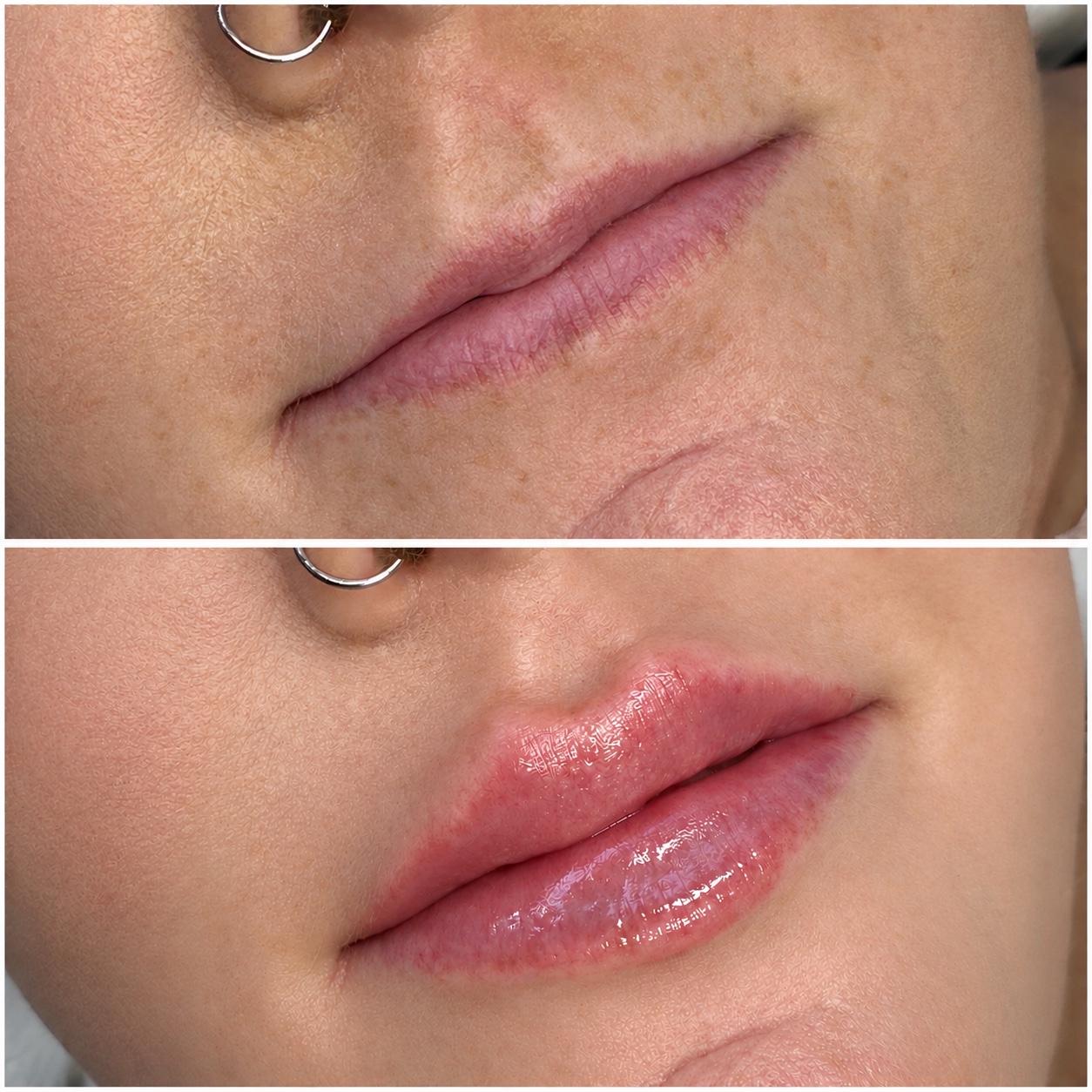 Lip treatment result