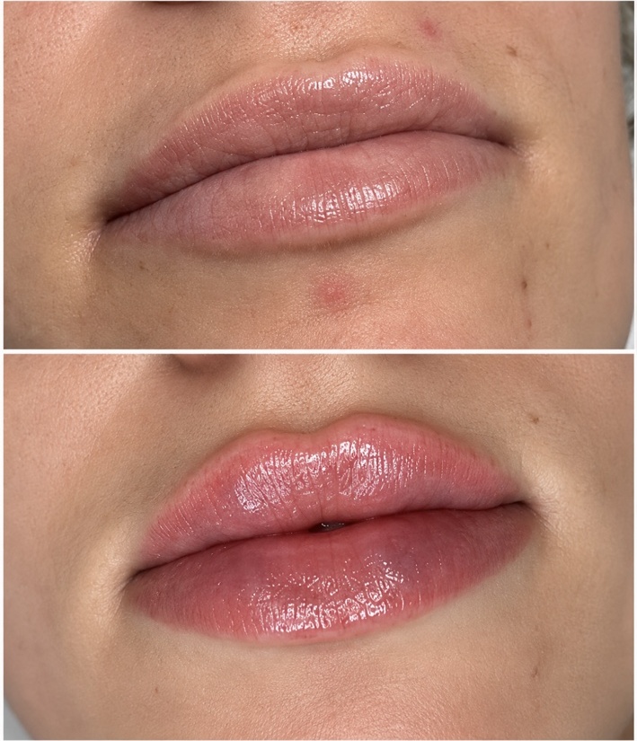 Natural-looking lip filler result by The Brow Club Aesthetics in Portsmouth
